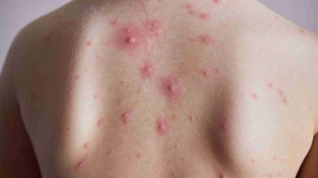 إيطاليا تسجل أكثر من 400 حالة إصابة بمرض جدري القردة