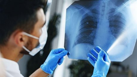 اليوم العالمي لسرطان الرئة.. نصائح مهمة للوقاية من المرض القاتل